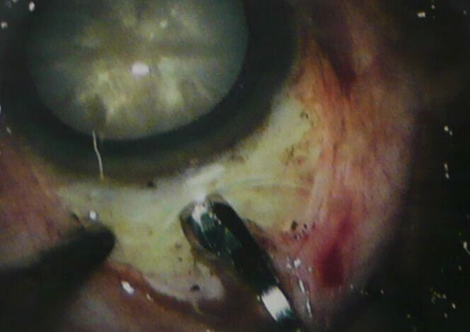 Augen OP in Paraguay