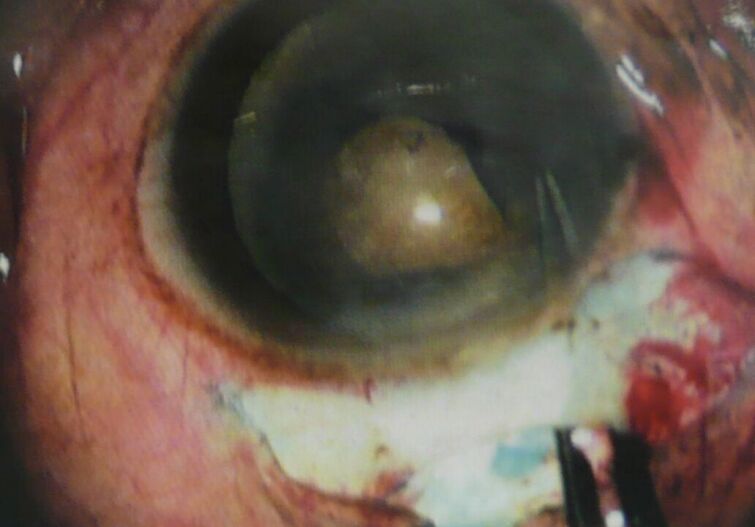 Augen OP in Paraguay