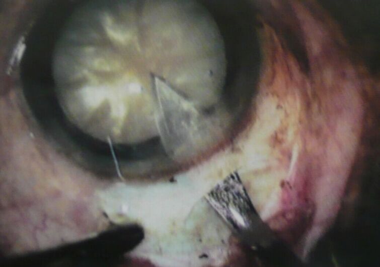 Augen OP in Paraguay