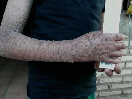  Firma Beiersdorf hilft  Cinthia mit Eucerin