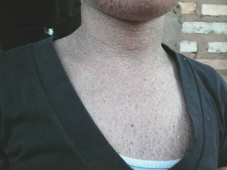  Firma Beiersdorf hilft  Cinthia mit Eucerin