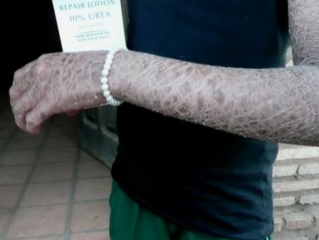  Firma Beiersdorf hilft  Cinthia mit Eucerin