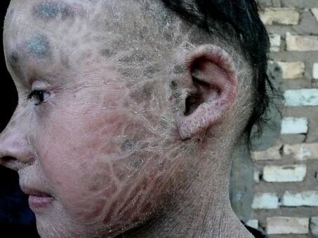  Firma Beiersdorf hilft  Cinthia mit Eucerin